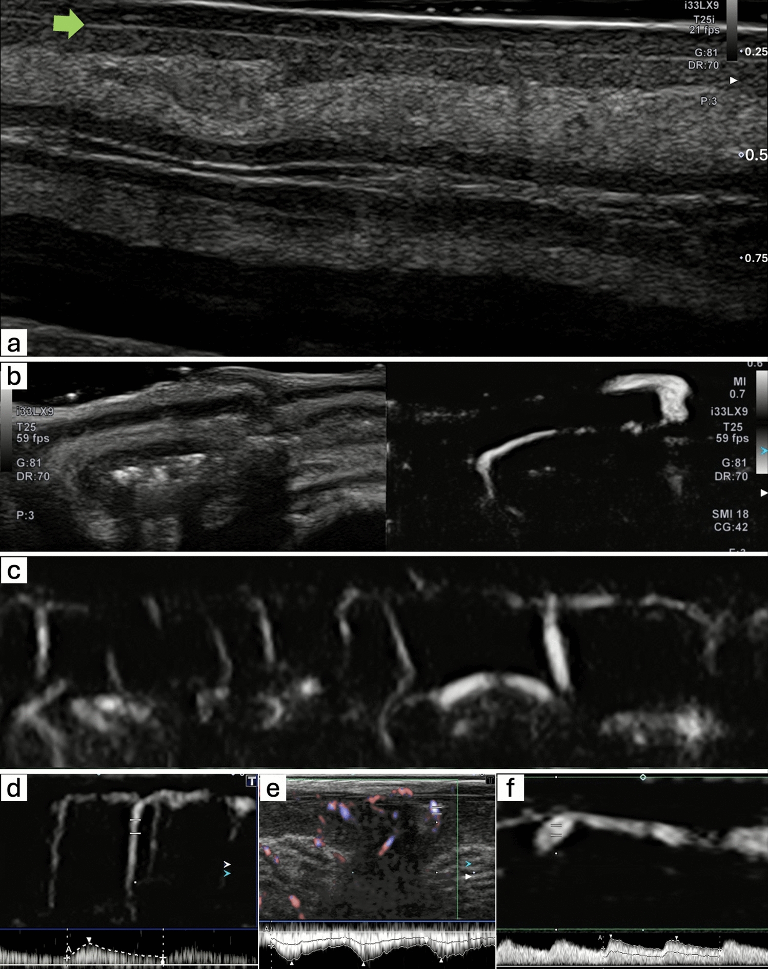 Real-time visualization of human colonic vascular architecture using 33-MHz high-frequency ultrasound and superb microvascular imaging