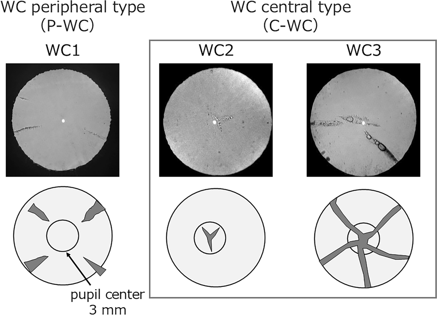 Impact of watercleft localization on higher-order aberrations and visual function