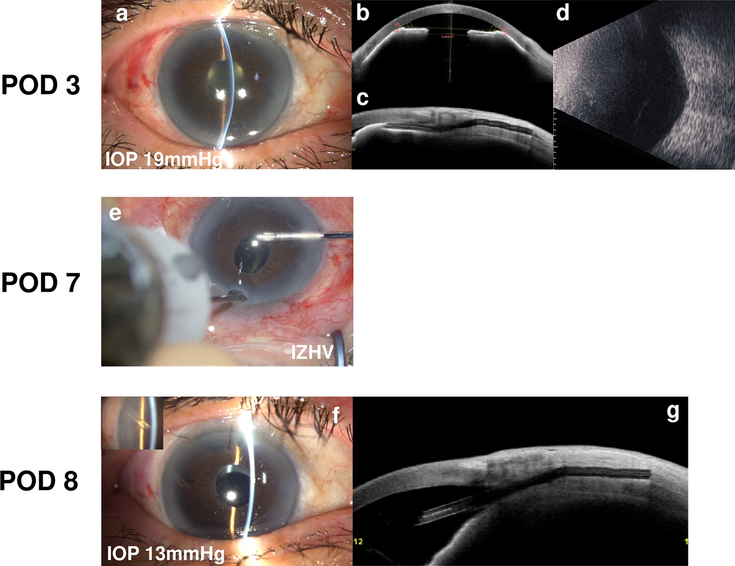 Incidence and clinical features of malignant glaucoma after Preserflo MicroShunt implantation