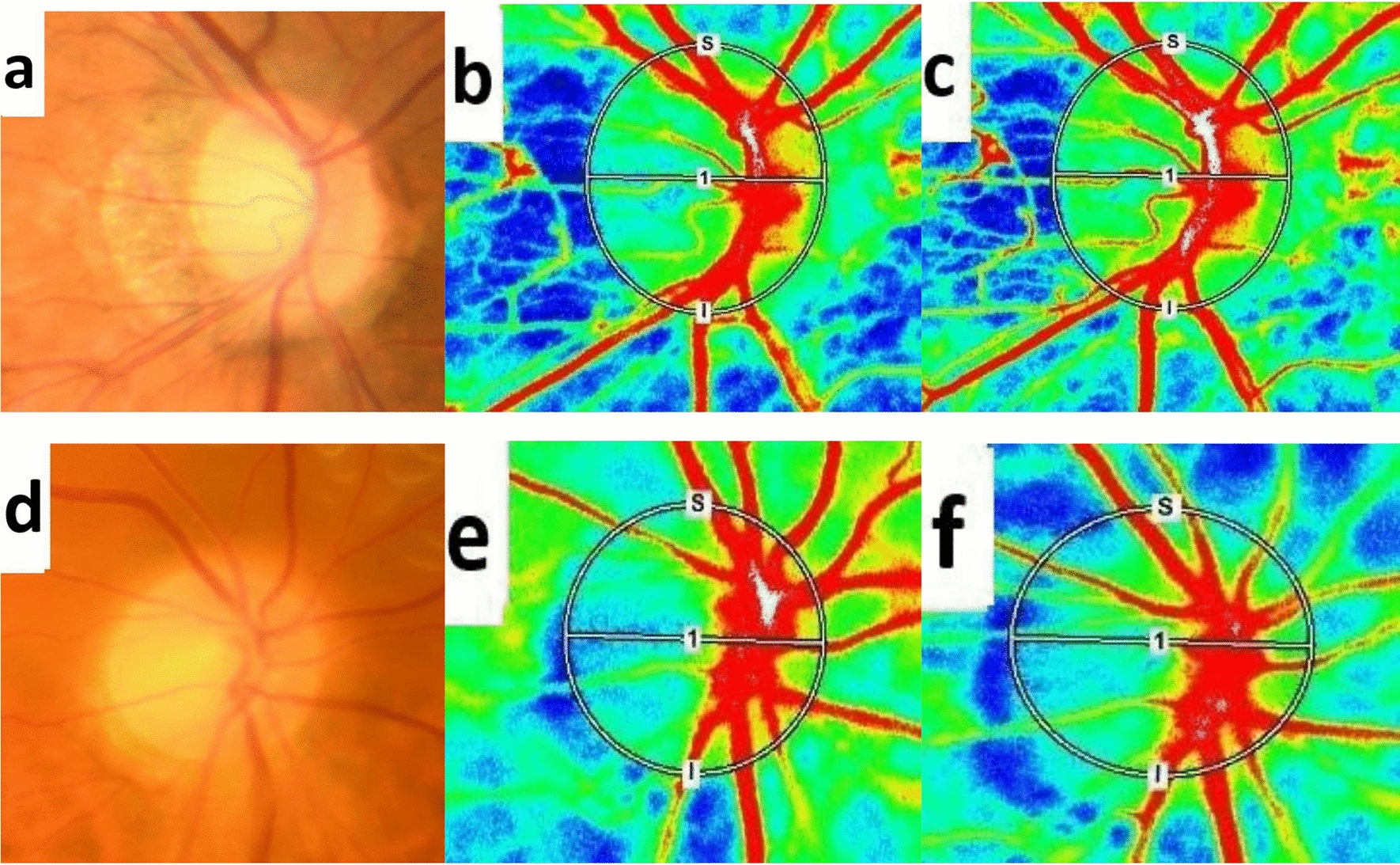 Significant correlation between retinal blood flow and visual acuity in recovery after vitrectomy for rhegmatogenous retinal detachment with macular detachment