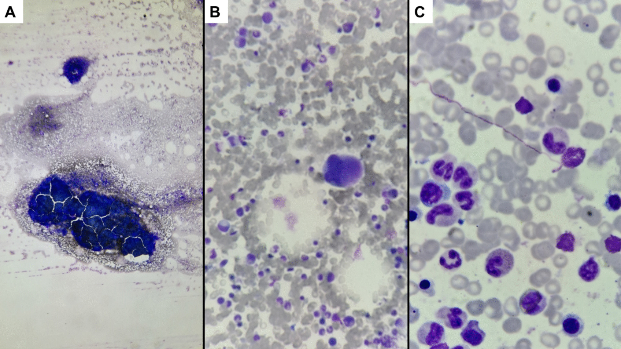 The importance of bone marrow biopsy for chronic myeloid leukemia classification—a case report