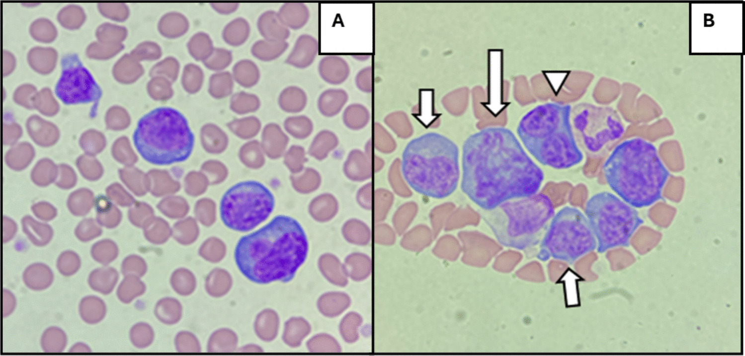 A case of transient monoclonal plasma cell aberrancy following respiratory syncytial virus (RSV) vaccination