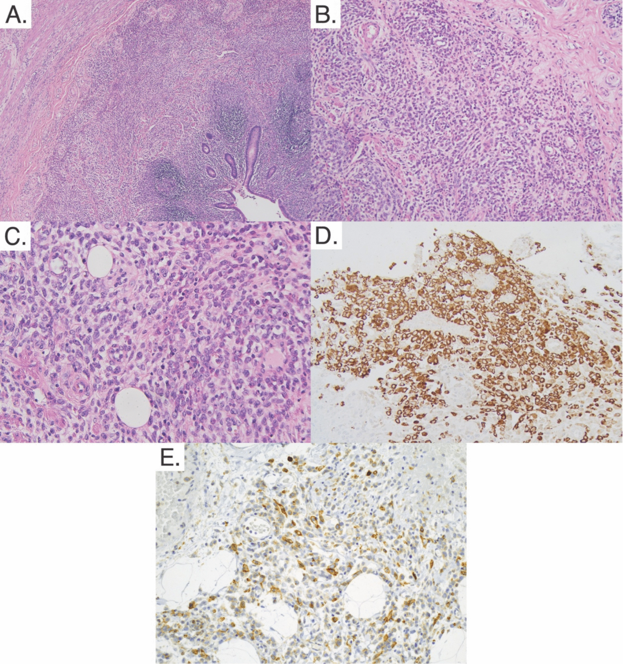 Leukemic appendix with clinical presentation that mimics acute appendicitis