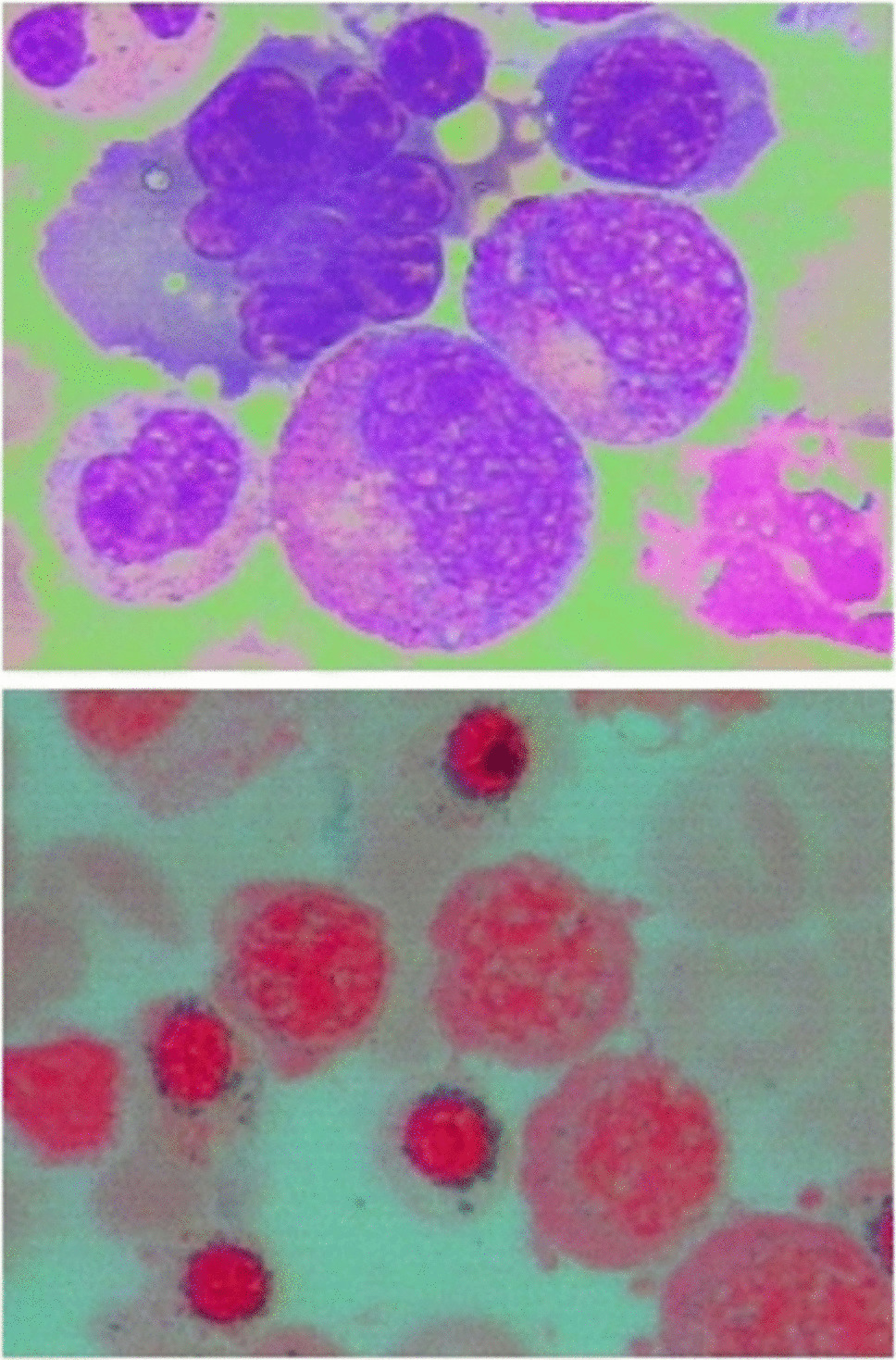B-cell acute lymphoblastic leukemia following myelodysplastic syndromes: a case report and literature review