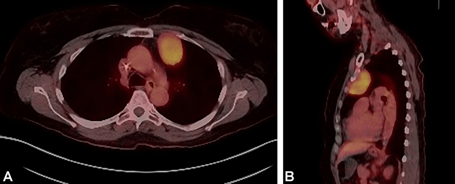 A pleura-based follicular dendritic cell sarcoma with epithelioid morphology and aberrant expression of cytokeratins