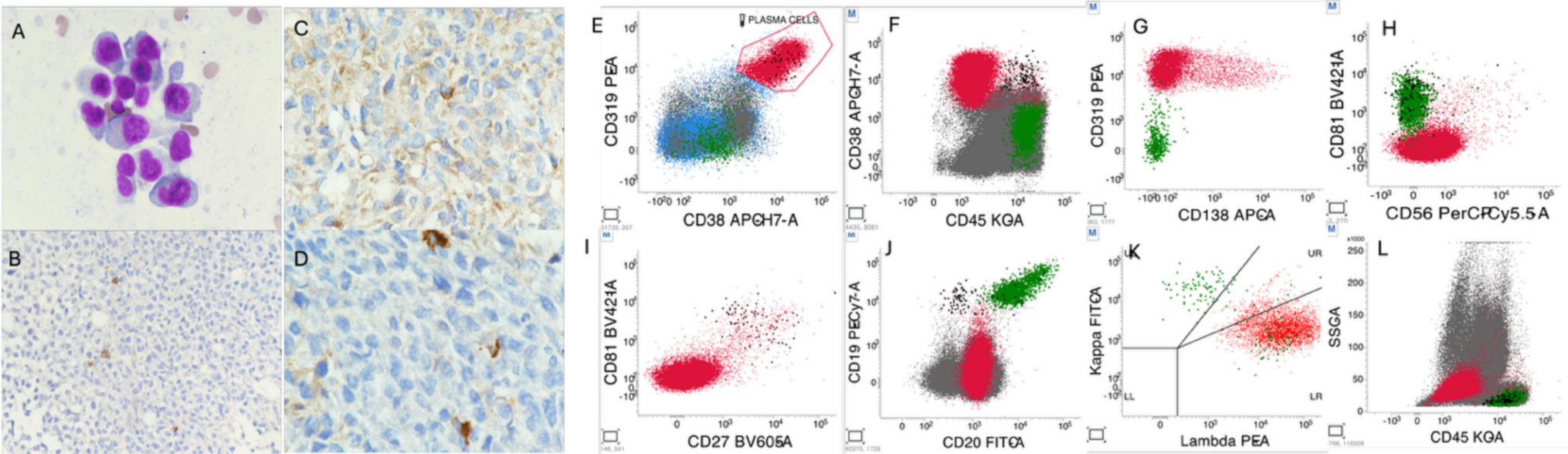 Rare CD138 negative plasma cell leukemia with pleomorphic morphology—CD319 to the rescue when traditional markers fail
