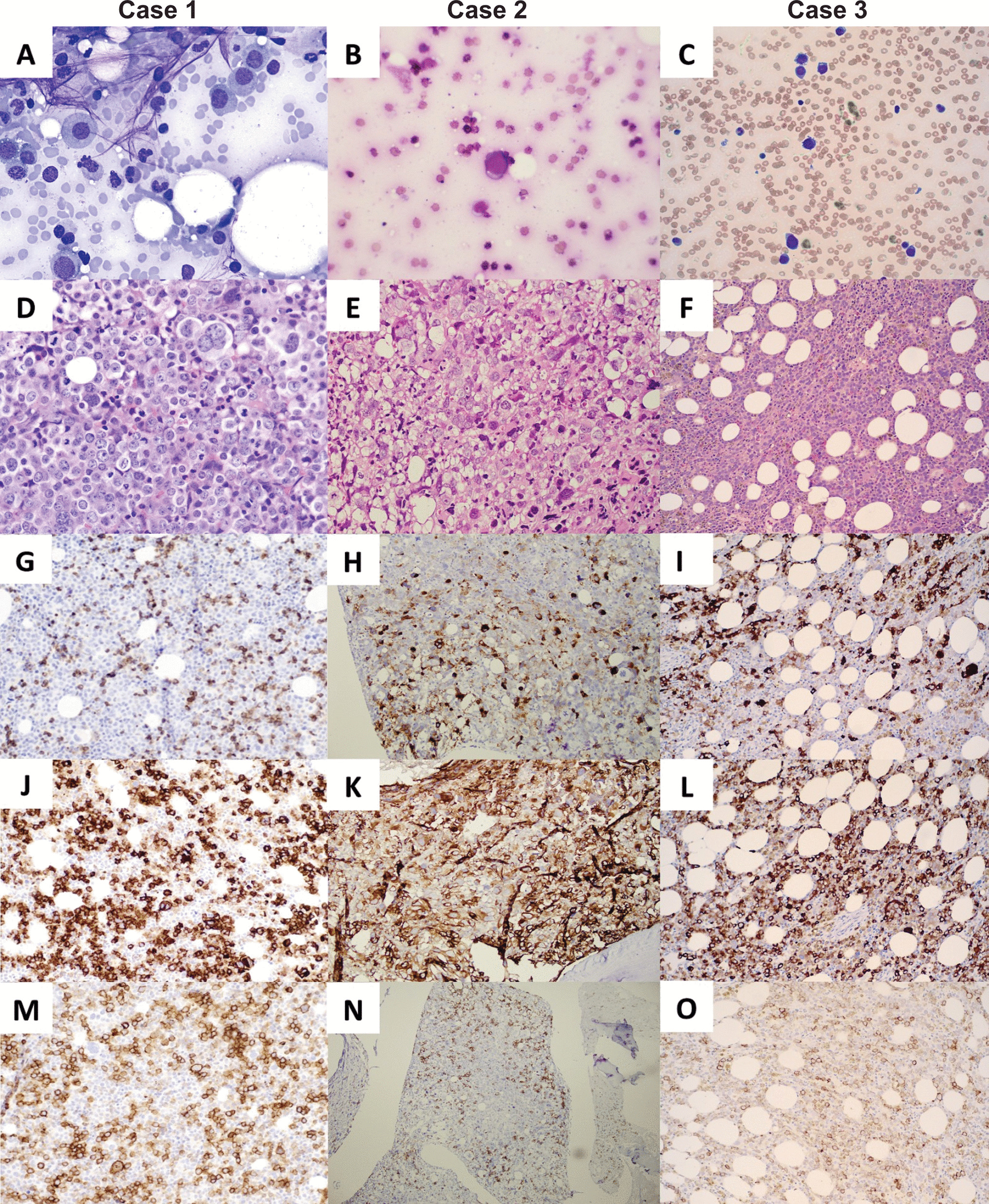 Acute myeloid leukemia with bipotential erythroid and megakaryocytic differentiation: a case series and literature review