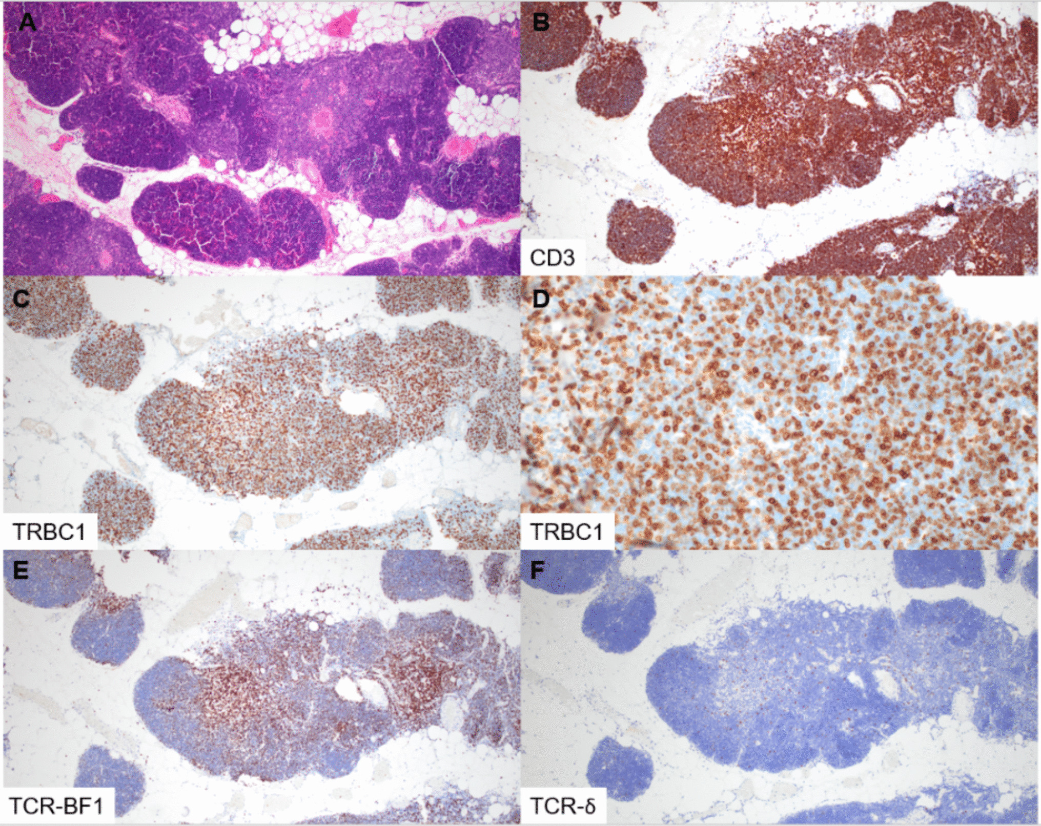Immunohistochemical evaluation of T cell receptor and T cell receptor beta constant 1 expression distinguishes benign and neoplastic immature T-cell populations and reveals discrete TRBC1/TCR phenotypes