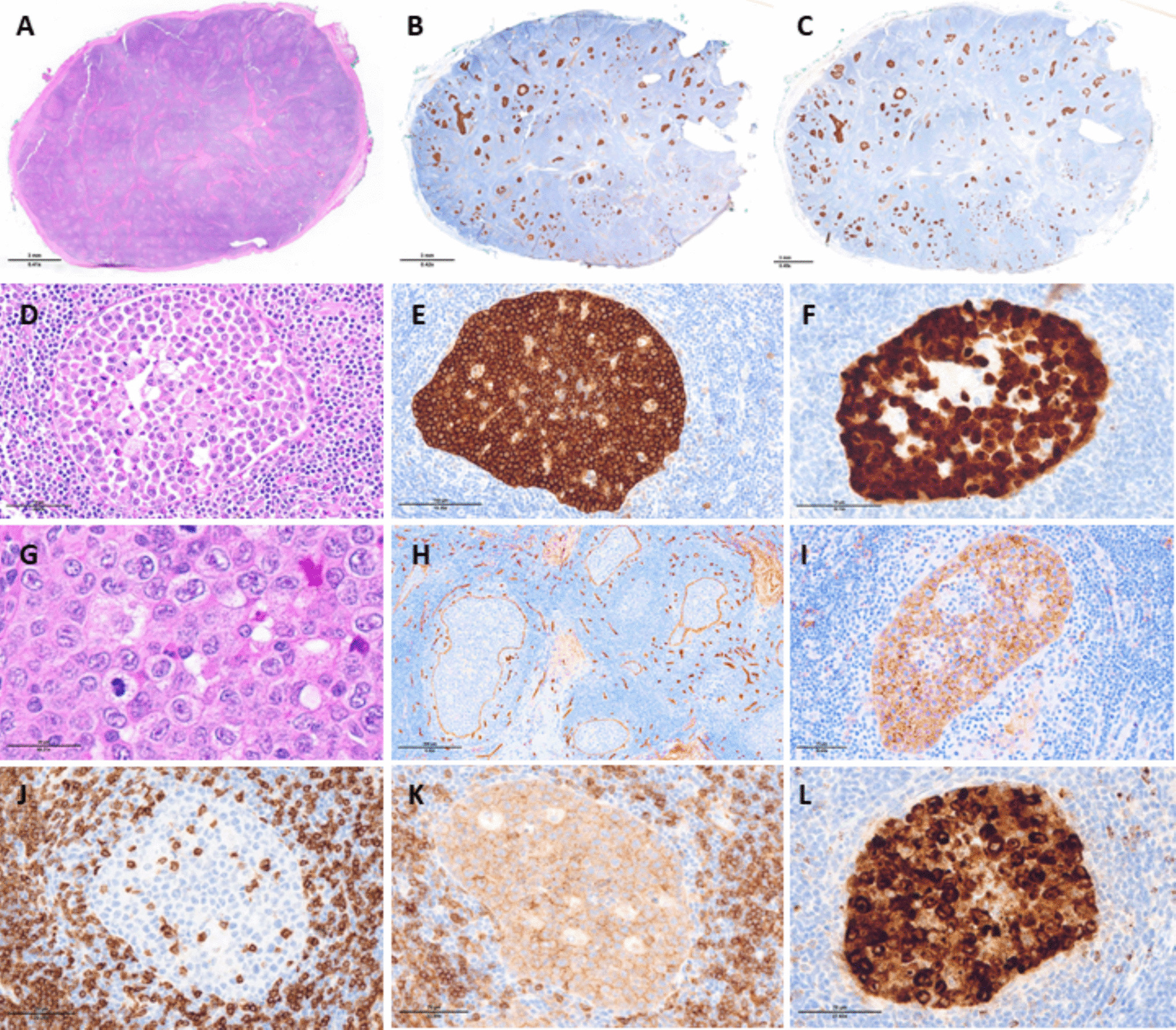 Intrasinusoidal ALK-positive anaplastic large cell lymphoma