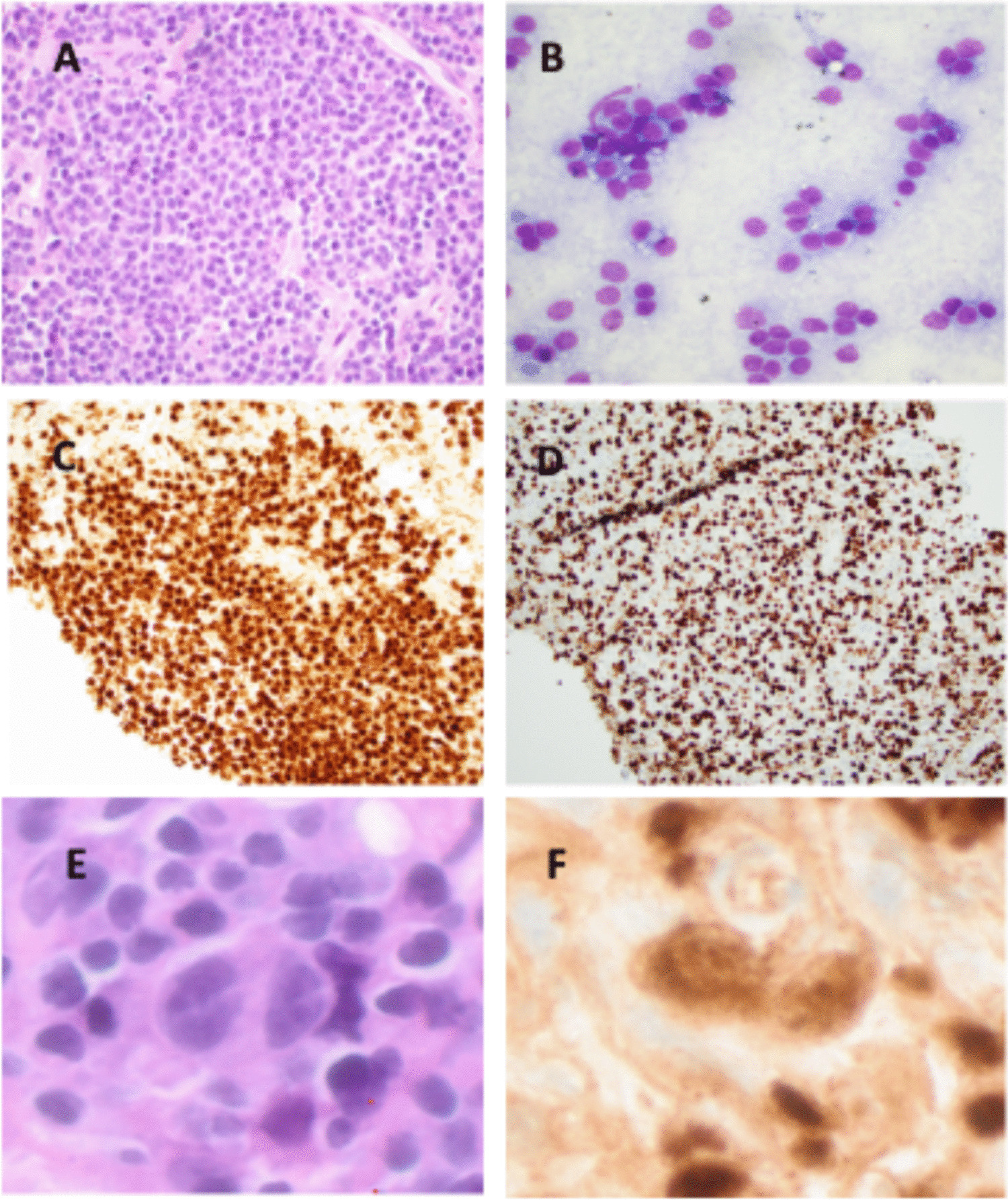 Mantle cell lymphoma transformation to CD19-negative classic Hodgkin lymphoma as a novel mechanism of escape from CD19 chimeric antigen receptor T cell therapy