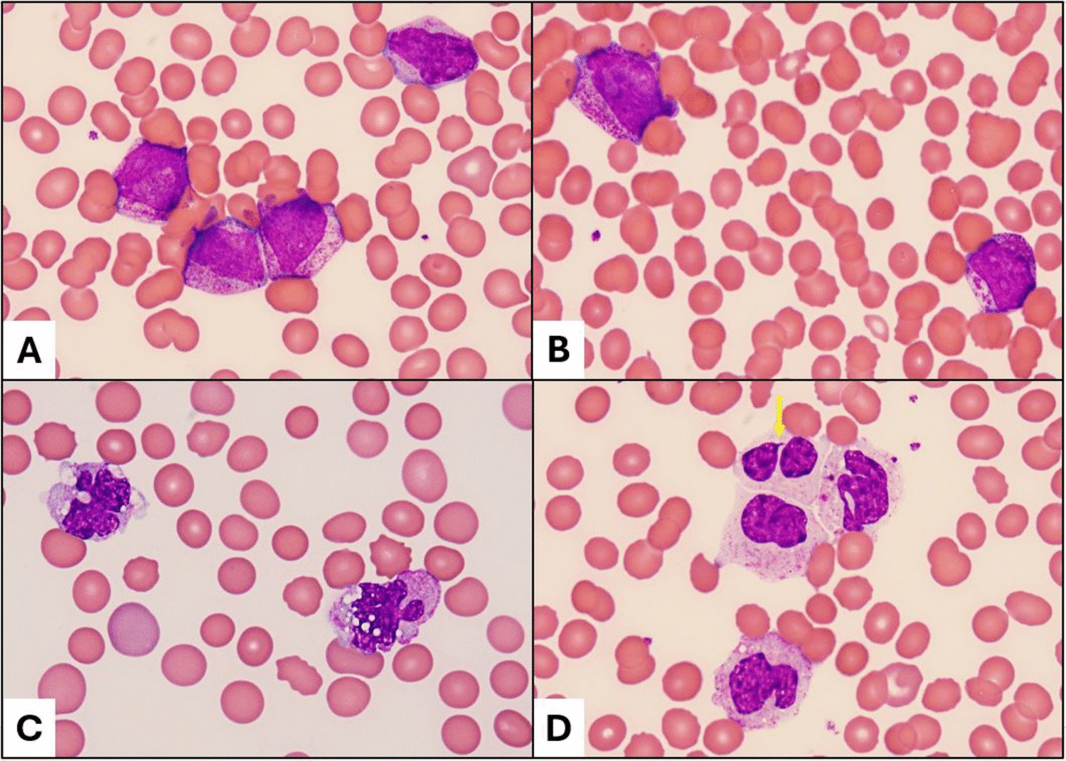 Acute promyelocytic leukemia with a rare  fusion and distinctive morphologic and phenotypic attributes