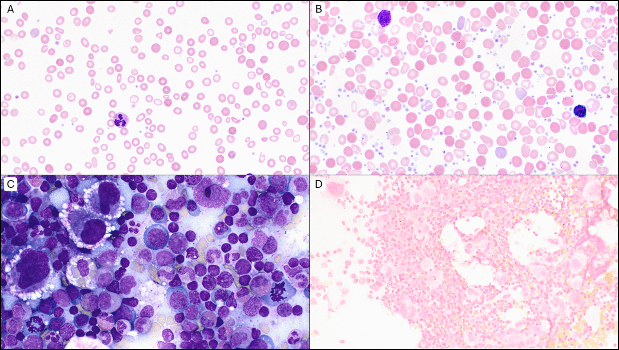 From famine to feast: a seesawing platelet count in severe iron deficiency anemia