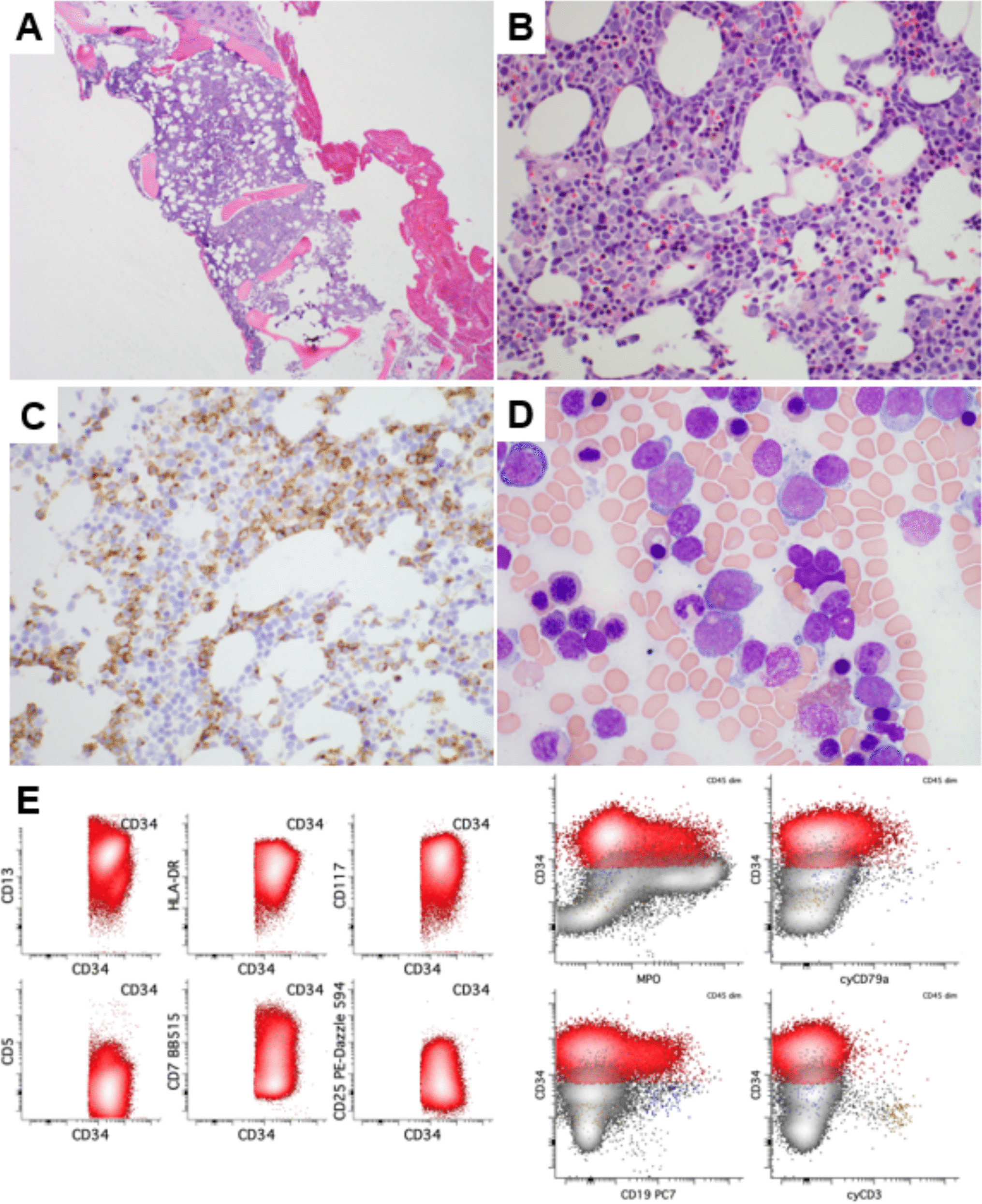 A novel  fusion associated with inversion of chromosome 7, inv(7)(p13q32), in relapsed acute myeloid leukemia