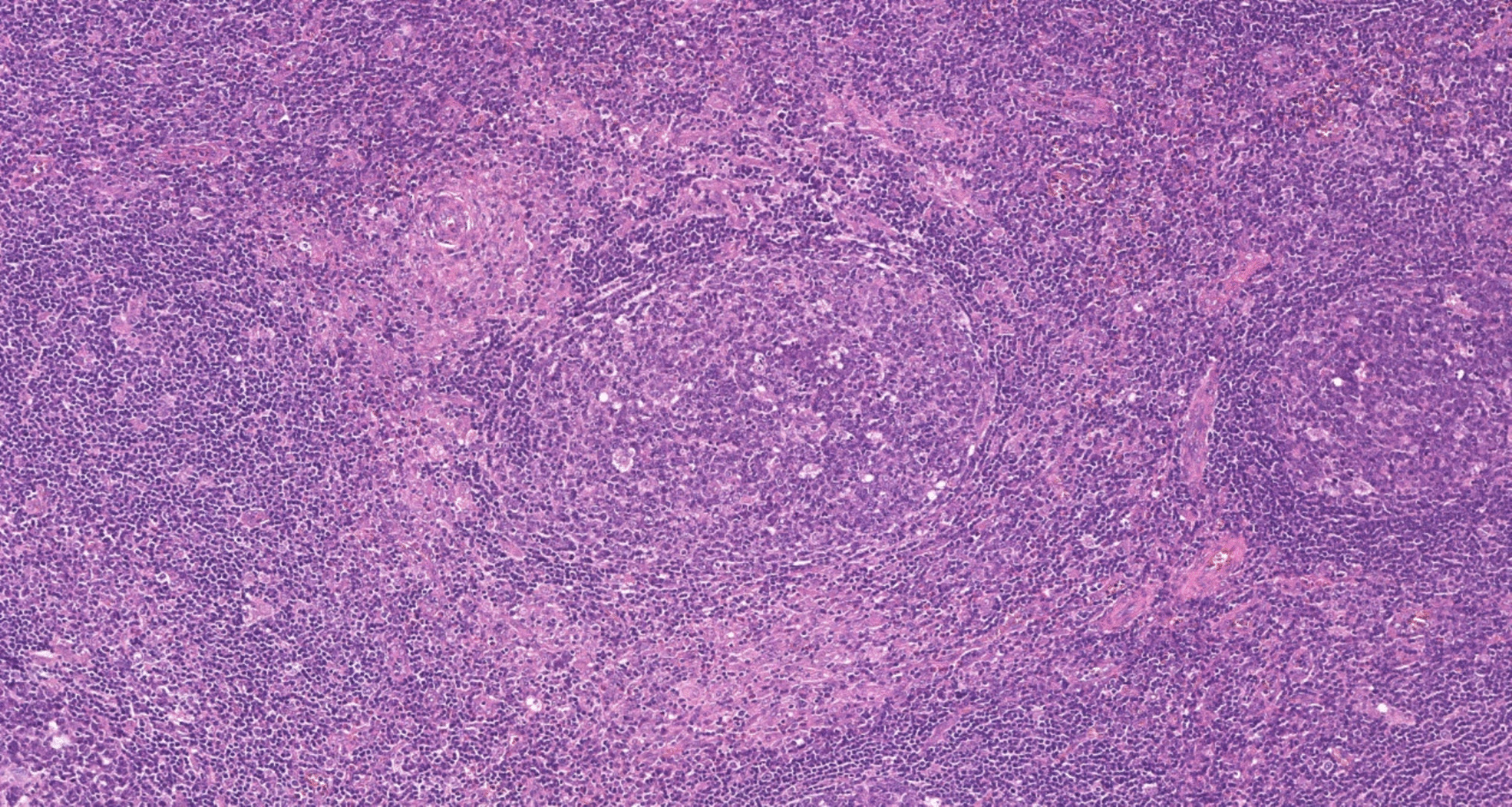 IgG4 plasma cells in hematopathology: beyond IgG4-related disease