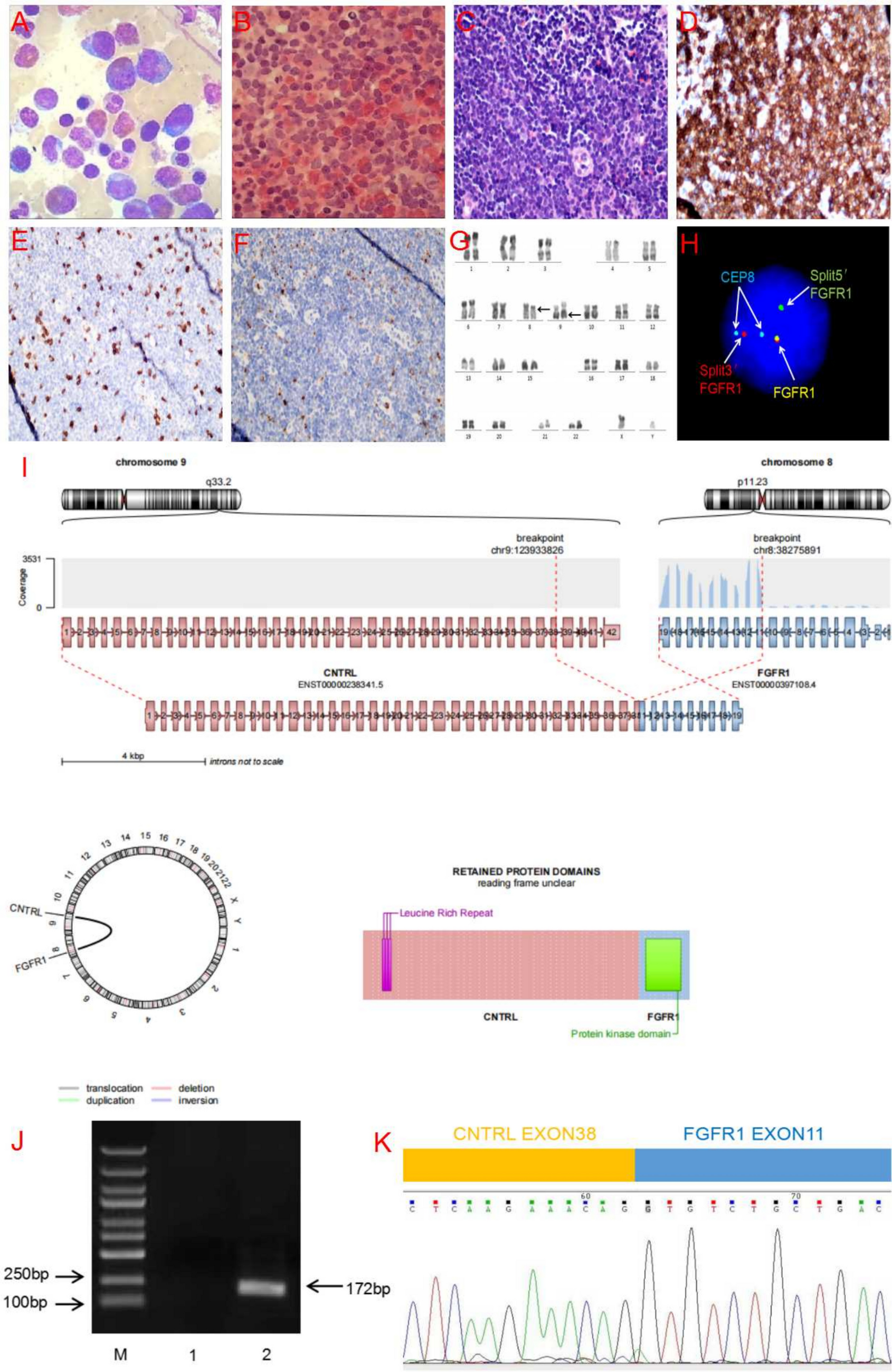 A novel splicing variant of :: in myeloid/lymphoid neoplasm with eosinophilia and rearrangement of