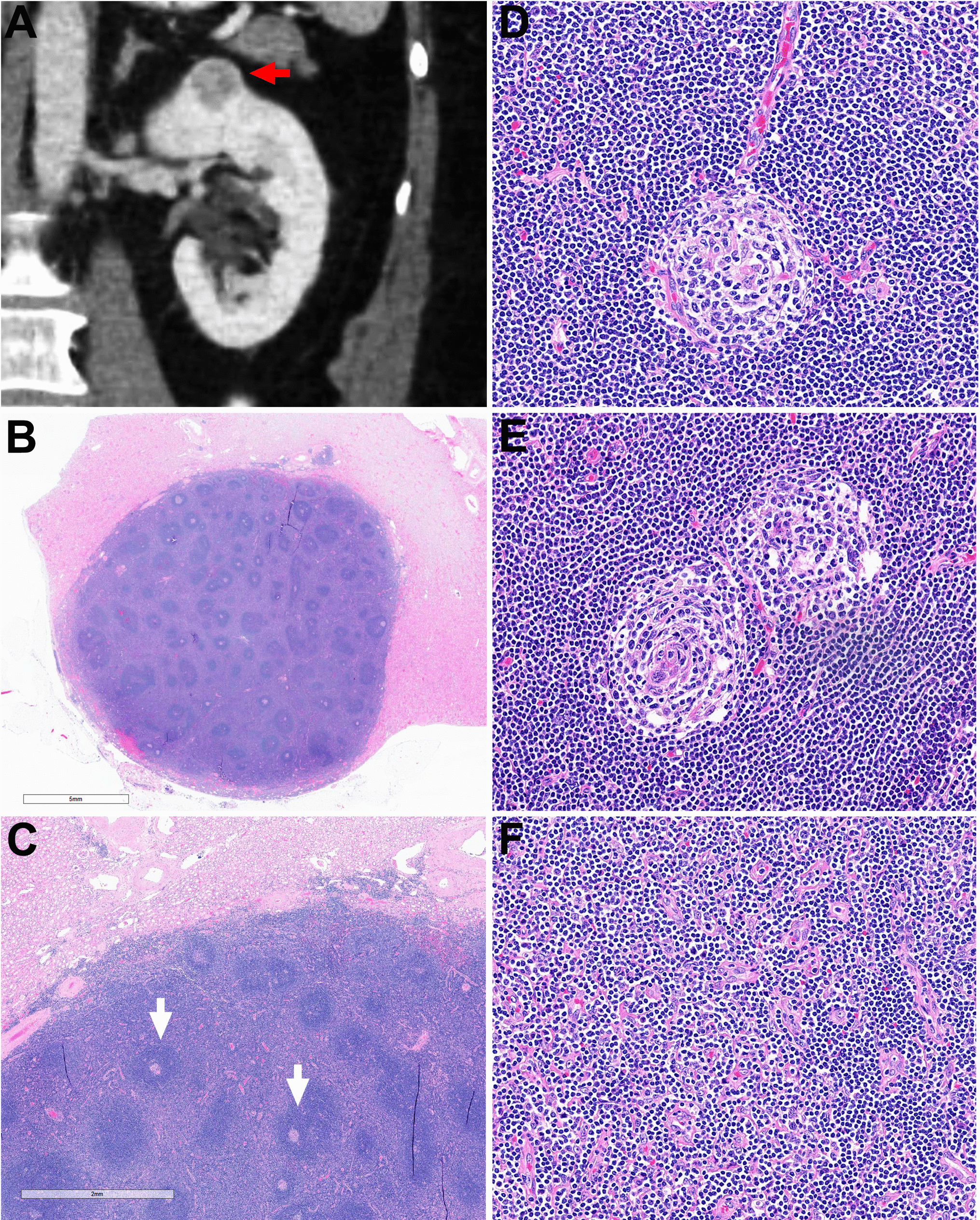 Primary hyaline vascular Castleman disease in the kidney: a report and brief literature review