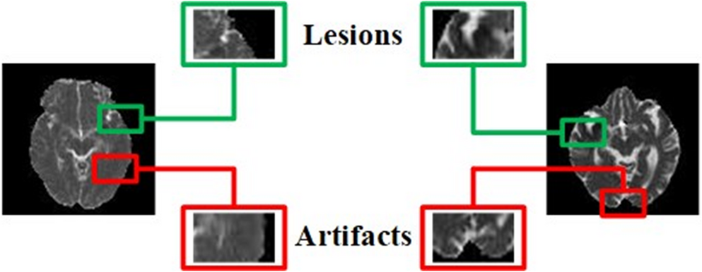 Ischemic stroke lesion segmentation in the acute phase using automated deep U-Net model
