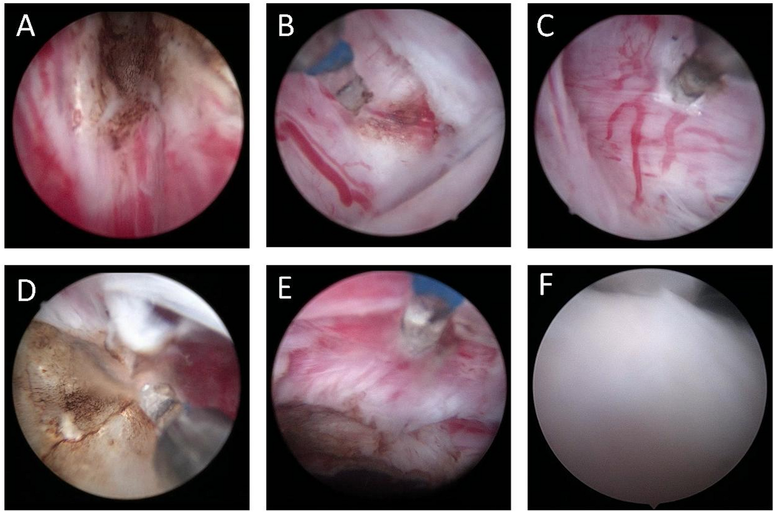The efficacy and safety of 1470 nm diode laser in the treatment of benign prostatic hyperplasia: a prospective, multicenter study