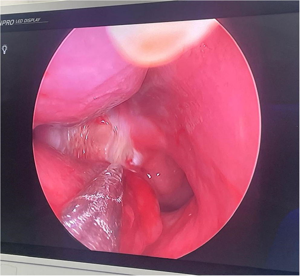 Diode laser posterior nasal neurectomy with or without partial posterior turbinectomy in patients with intractable vasomotor rhinitis: a prospective comparative study