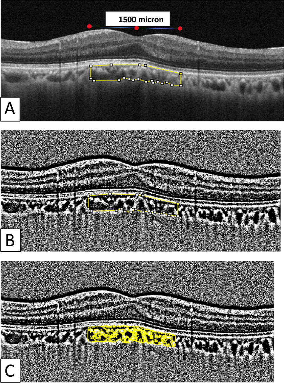 The evaluation of choroidal vascular index in the patients undergoing surgical treatment for retinal detachment