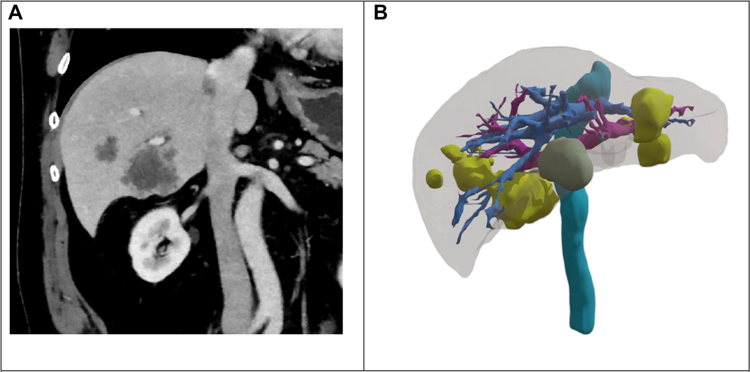 The Clinical Utility of Three-Dimensional Liver Modelling: A Multicenter Survey