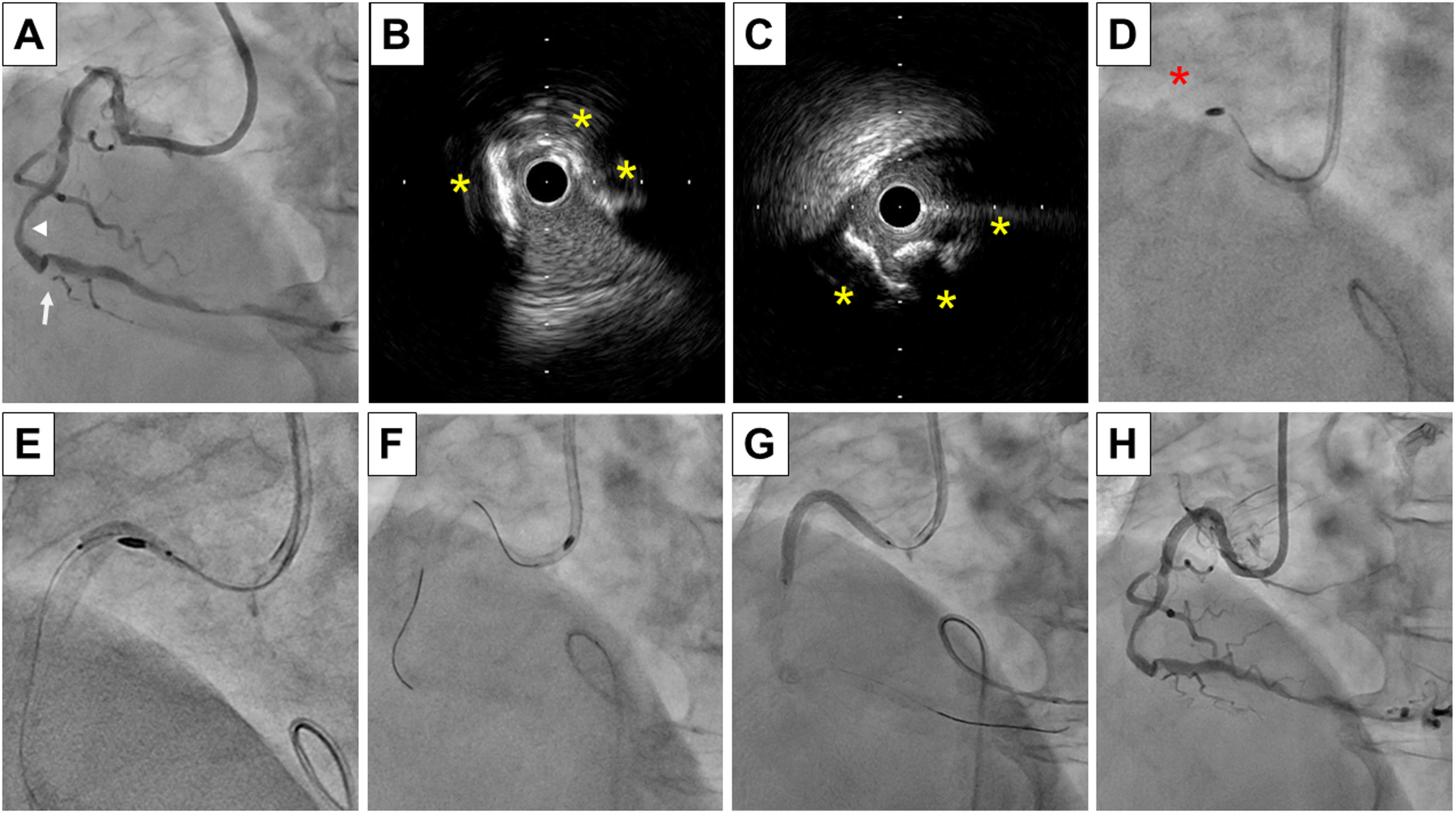 A novel bailout method for rotational atherectomy burr entrapment using intravascular lithotripsy