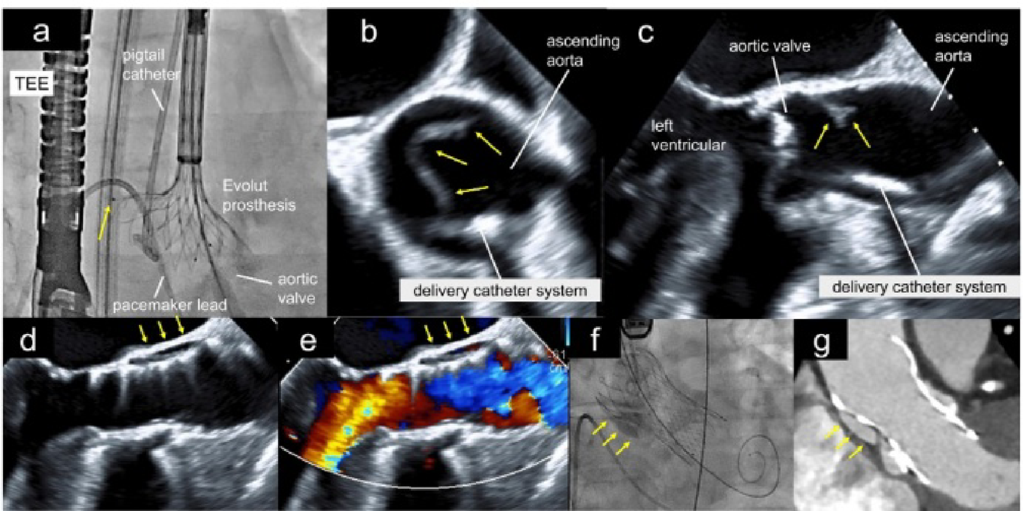 A novel mechanism of iatrogenic aortic dissection: interference between an evolut prosthesis and a pigtail catheter during the TAVI recapture procedure