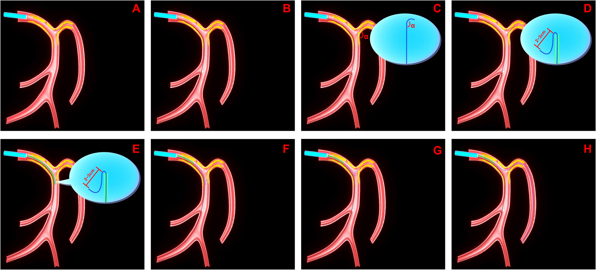 Single-lumen microcatheter based reversed wire technique (RWT) in the treatment of extremely angled coronary bifurcation lesions