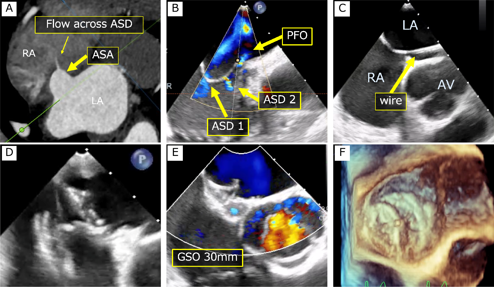Folding atrial septal aneurysm to close multi-fenestrated ASDs and a PFO with a single device