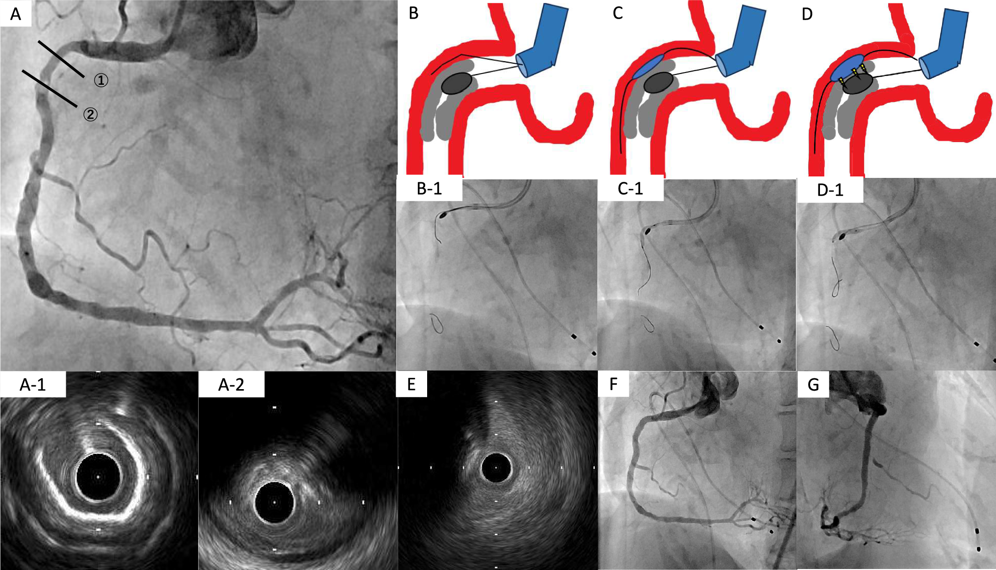 Successful retrieval of an entrapped rotational atherectomy burr using intravascular lithotripsy from false lumen
