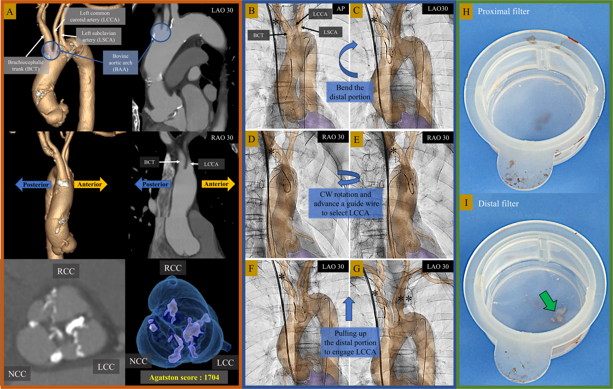 Integrating computed tomographic images with real-time fluoroscopy for cerebral protection during transcatheter aortic valve implantation