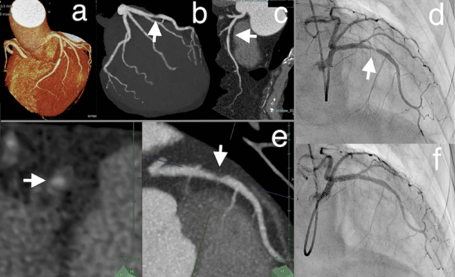 Consensus document on the role of cardiac computed tomography for pre-procedural planning in minimally invasive percutaneous coronary intervention from the Japanese association of cardiovascular intervention and therapeutics