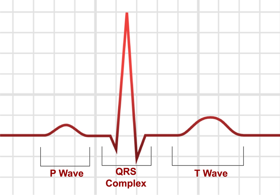 An augmented ECG data based classification for arrhythmia using optimal feature set