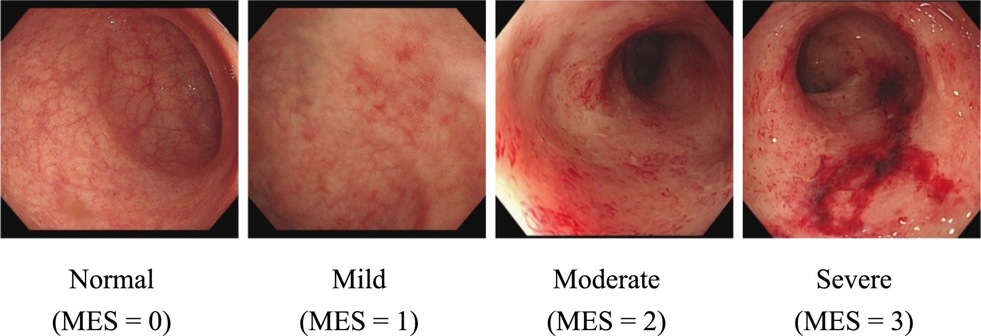 ACDW-InceptionNeXt: adjacent class distinguished and class distance weighted InceptionNeXt-based computer-aided mayo endoscopic scoring system for still images and video segments