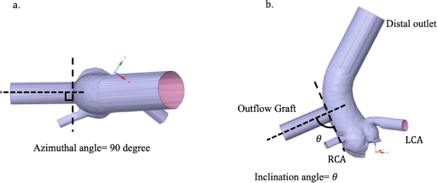 Hemodynamic analysis of the aortic root based on differences in outflow graft angle in patients with implantable left ventricular assist devices
