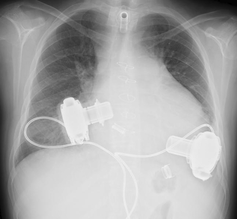 Bridge to heart transplantation with nearly 800-day intracorporeal biventricular assistance in a pediatric patient with Danon disease: a case report