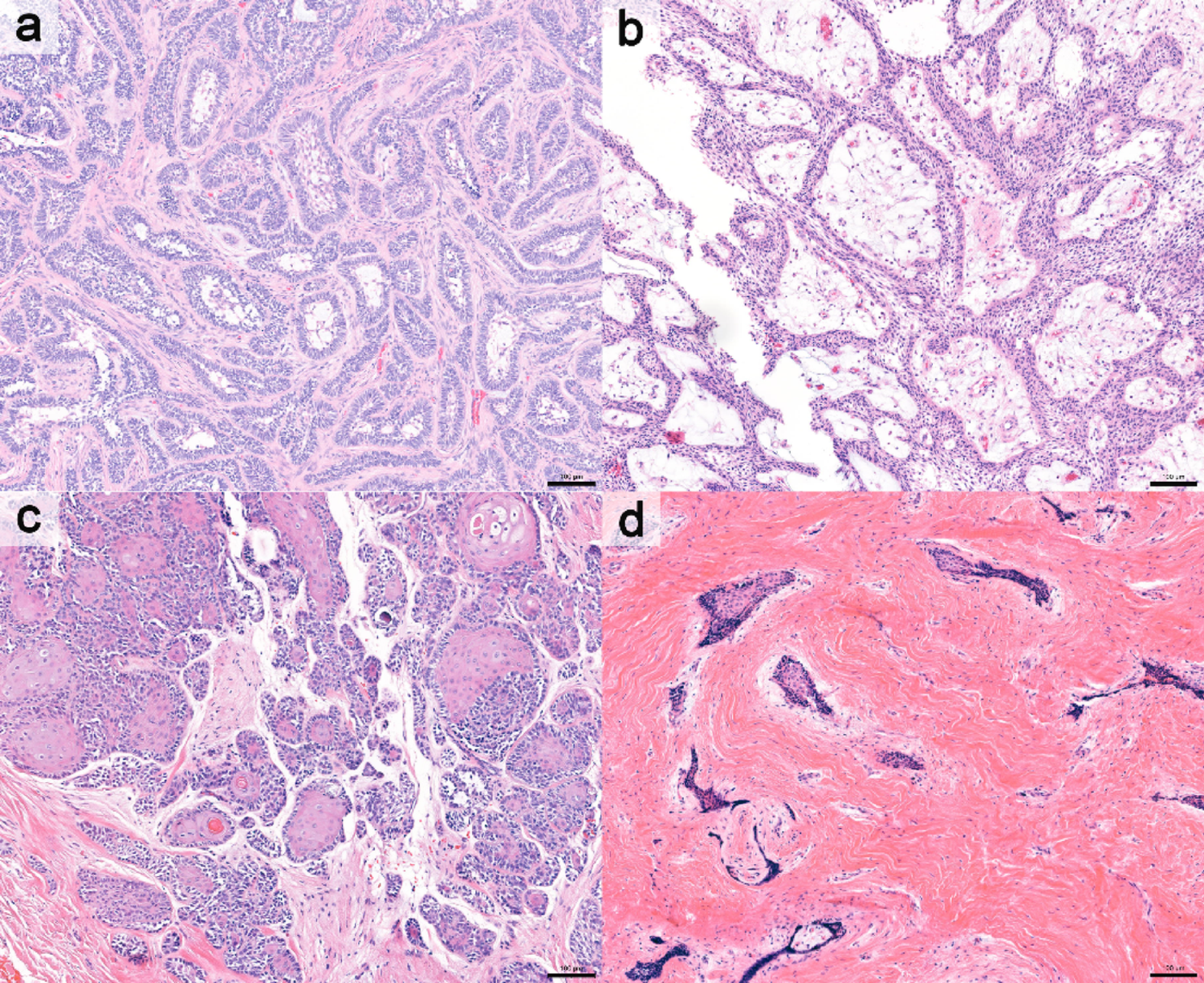 Epidemiology and Clinicopathologic Features with Prognostic Implications of Conventional Ameloblastoma: A 22-Year Retrospective Study