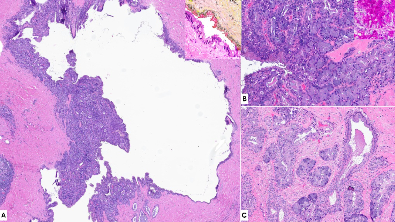 Mucoacinar Carcinoma of the Parotid Gland