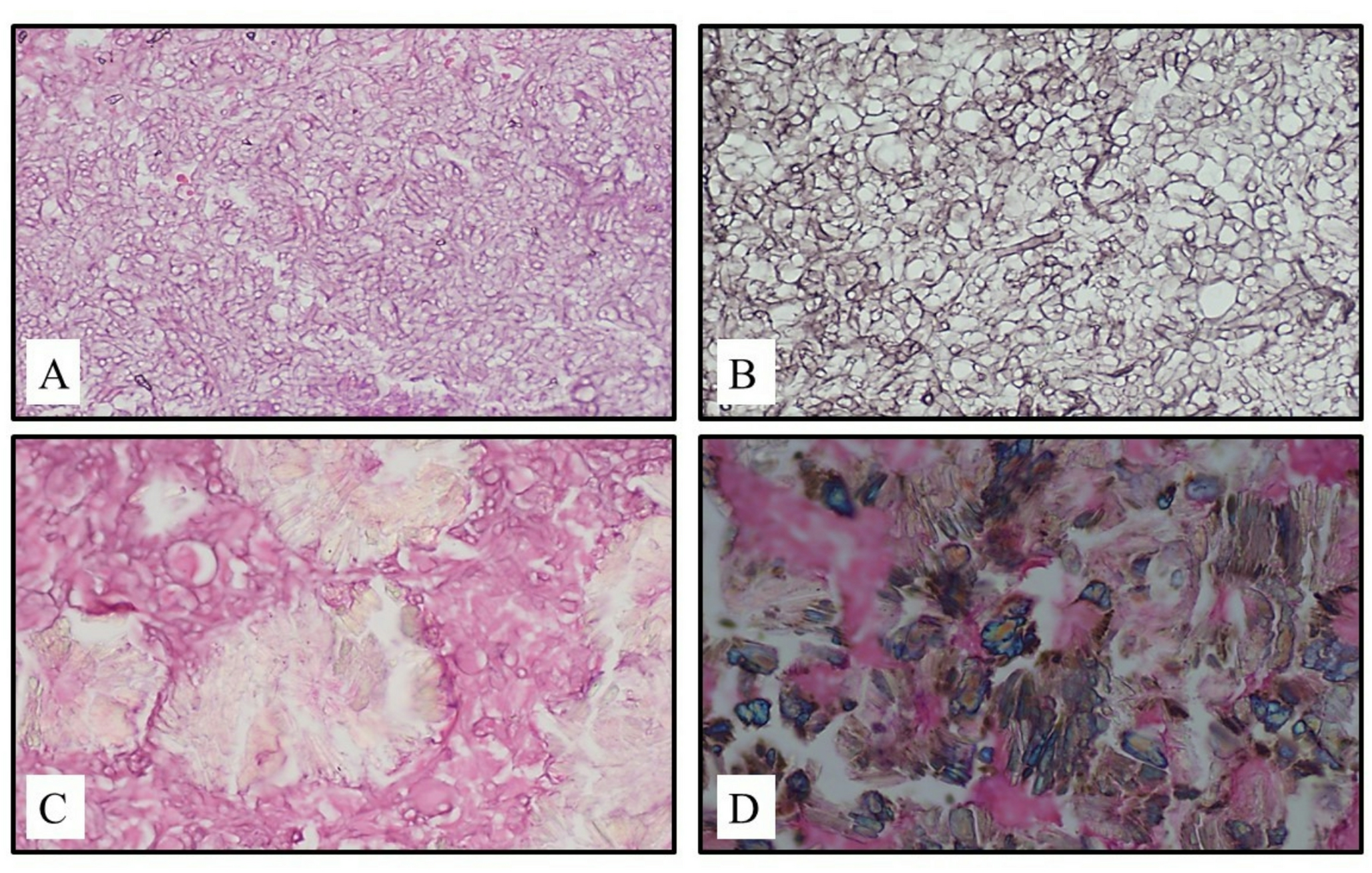 Mechanistic Insights into Calcium Oxalate Crystals in Aspergillosis of the Maxillary Sinus