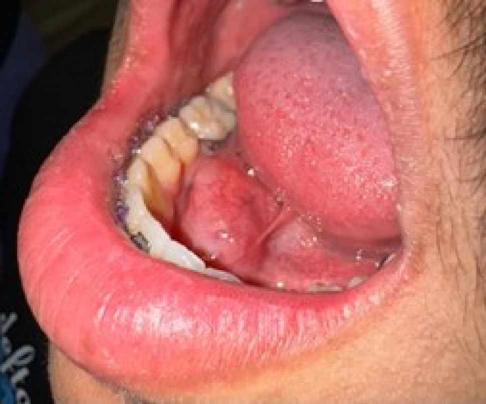 Novel Case of a Molecularly Confirmed Low-Grade Fibromyxoid Sarcoma of the Floor of the Mouth and Literature Review