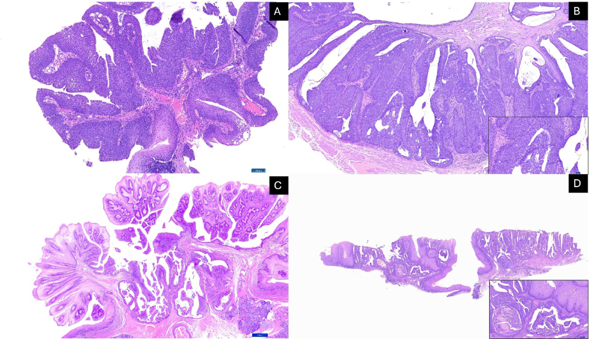 Intraductal Salivary Gland Neoplasms of the Oral Cavity: A Retrospective Case Series with Emphasis on Newly Described Entities