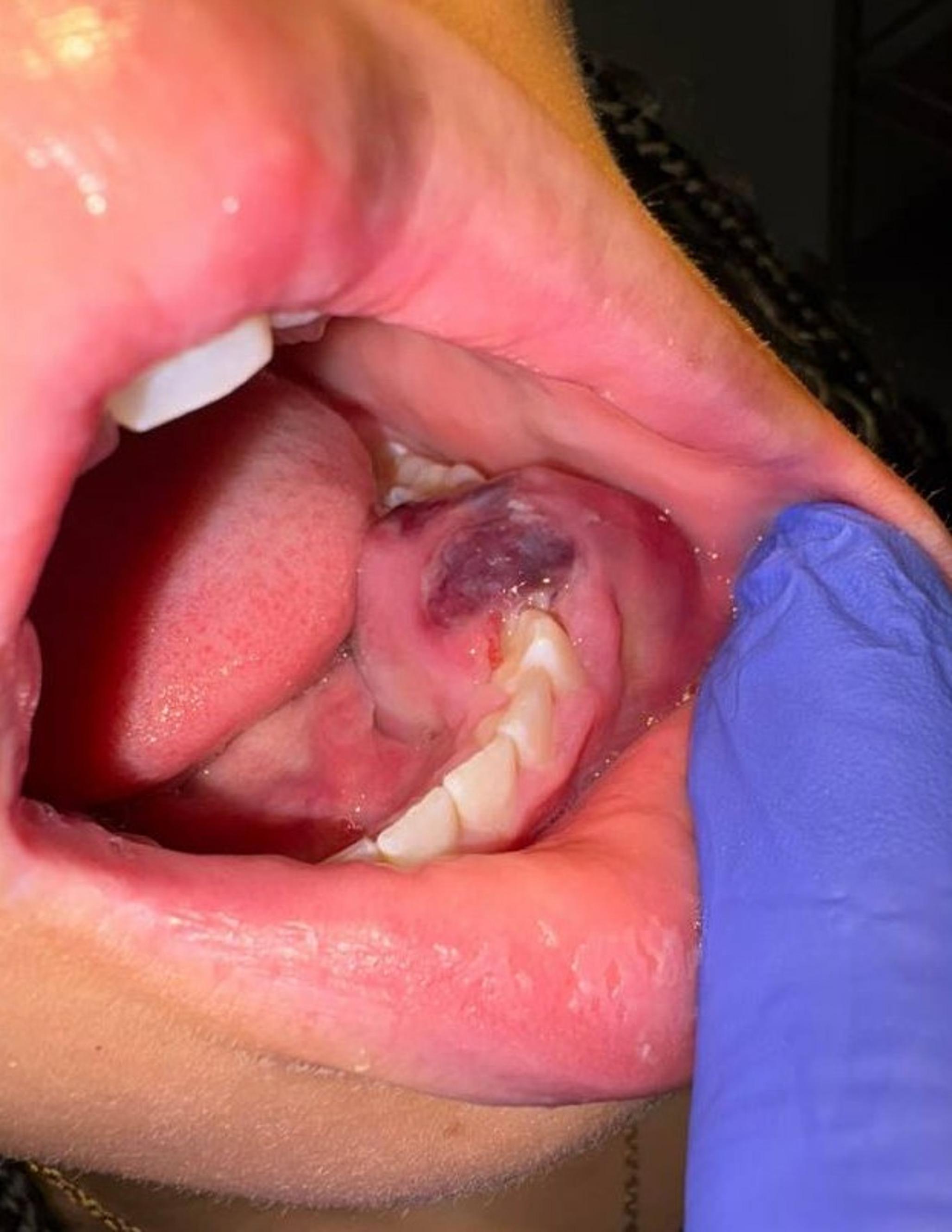 β-Human Chorionic Gonadotropin–Secreting Giant Cell Tumor of Bone in the Mandible: Case Report and Comprehensive Literature Review