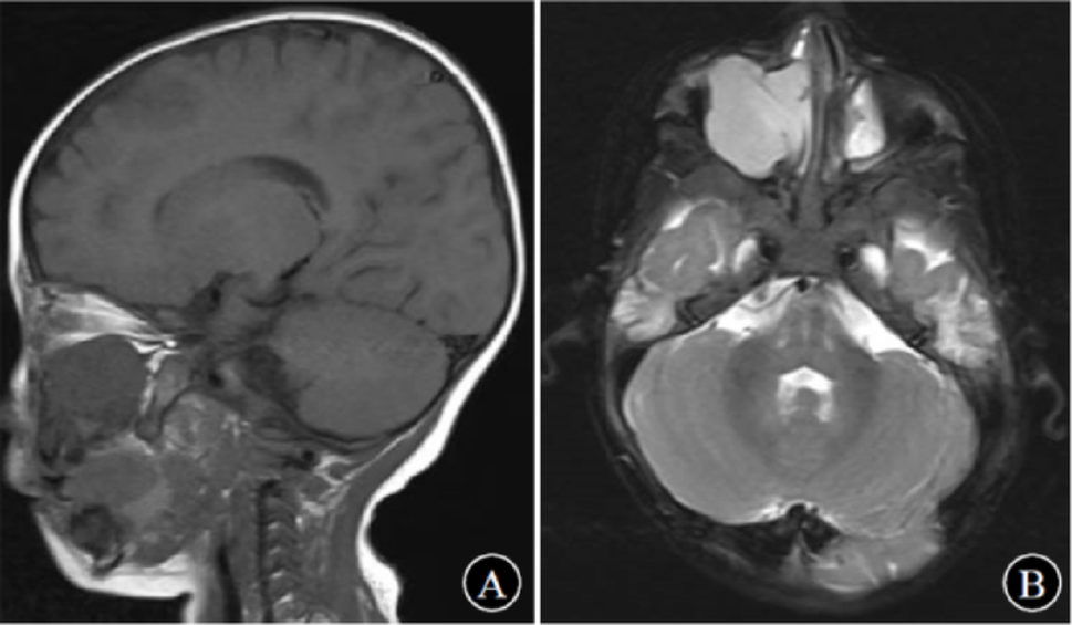A Case Report of Primitive Myxoid Mesenchymal Tumor of Infancy (PMMTI) with -ITD Genetic Alteration in the Sinonasal Cavity and Review of Literature
