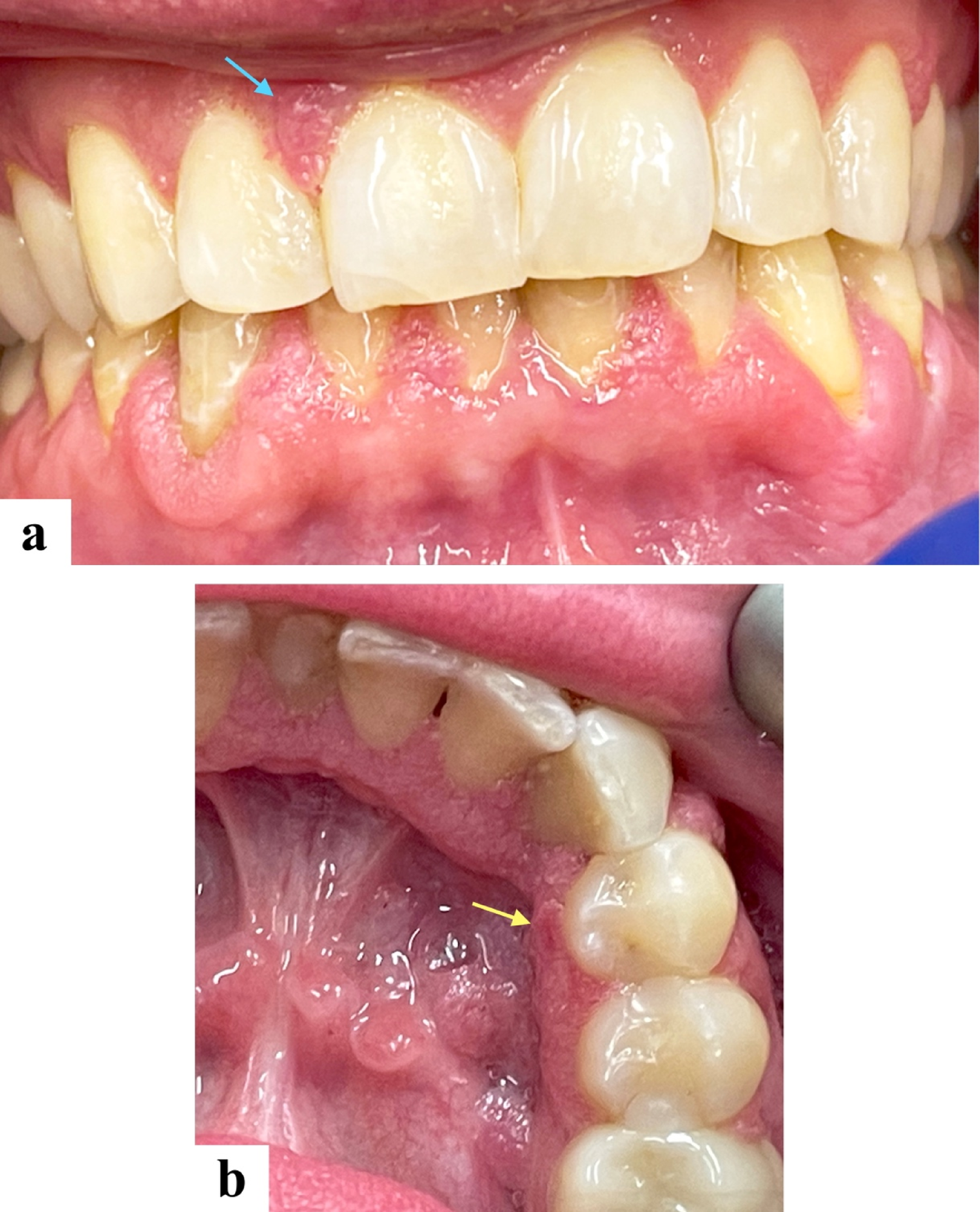 Oral HPV-Related Epithelial Proliferation during Fingolimod Therapy: First Case Report and Review of the Literature