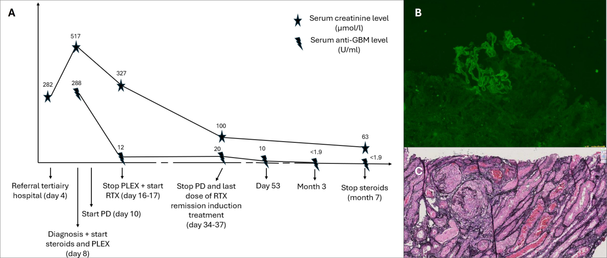Severe acute kidney failure due to double-seropositive anti-GBM glomerulonephritis in a child: a case for rituximab therapy
