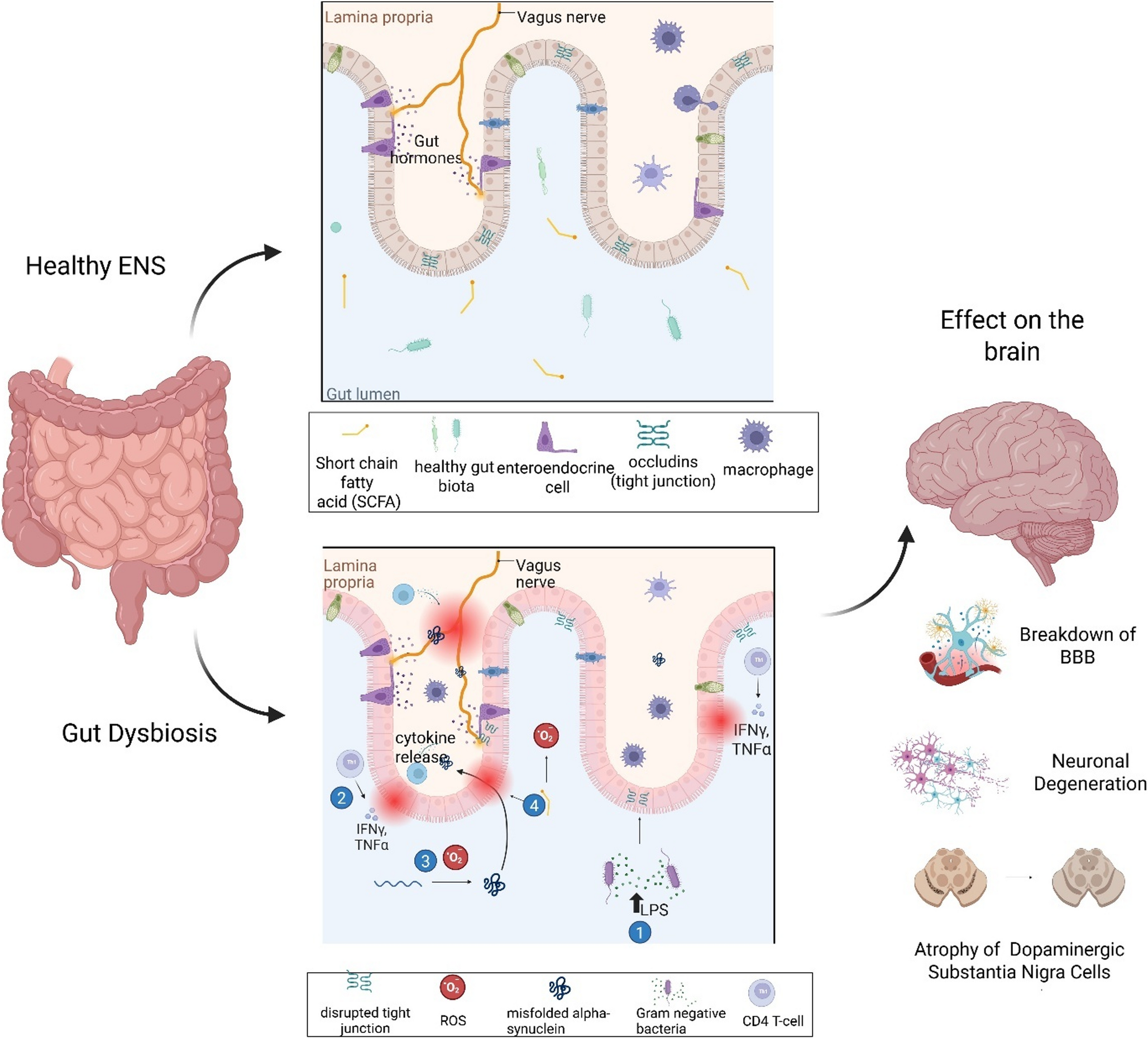 The role of gut dysbiosis in Parkinson’s disease: pathophysiology, epidemiology, and emerging therapeutic strategies