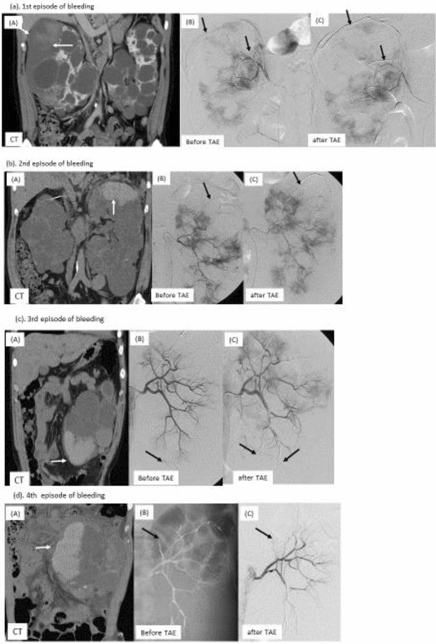 A case of autosomal dominant polycystic kidney disease with multiple bilateral spontaneous retroperitoneal hemorrhages