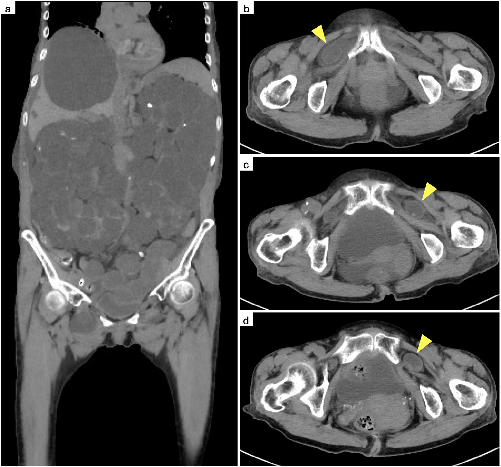 Recurrent obturator hernia in a patient with autosomal dominant polycystic kidney disease undergoing peritoneal dialysis: a case report