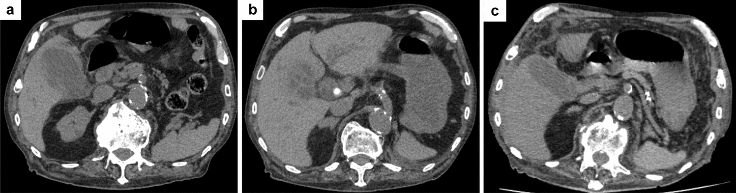 A rare case of obstructive shock caused by a giant biloma with right heart compression in a patient undergoing hemodialysis