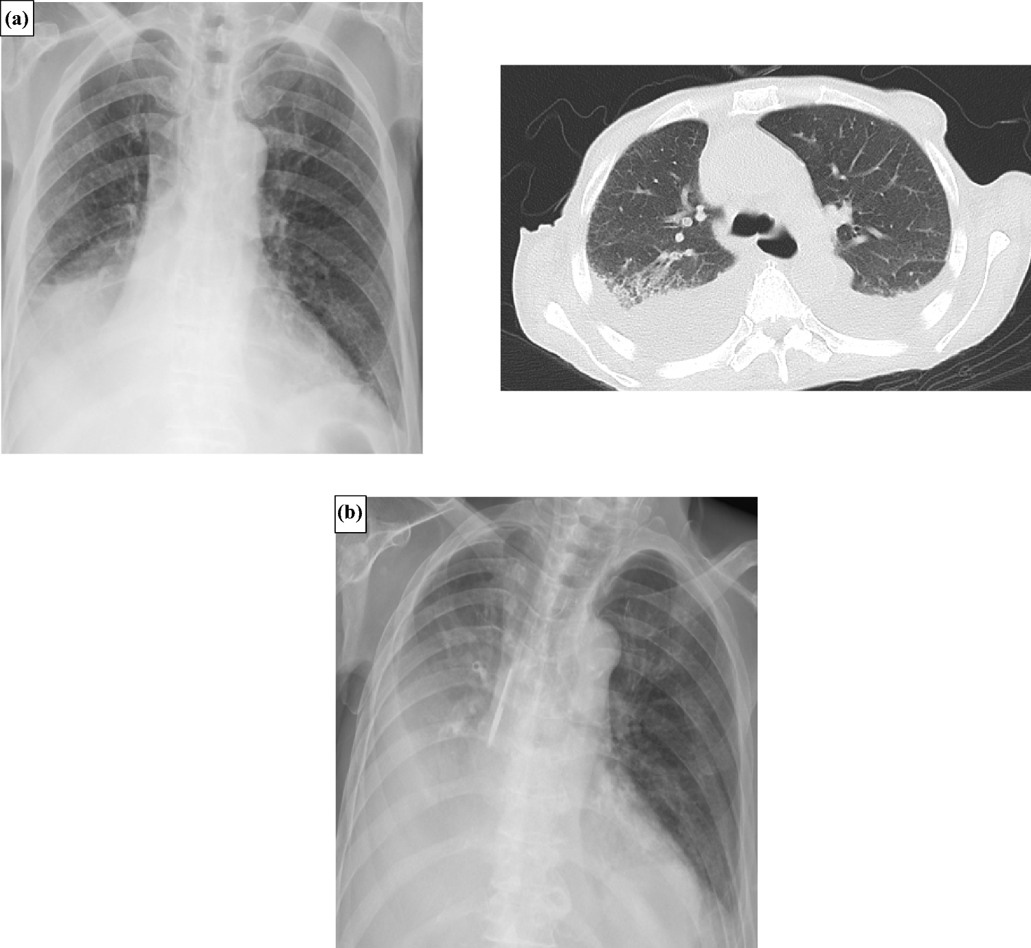 An autopsy-proven case of normotensive scleroderma renal crisis with refractory pleuroperitoneal effusion